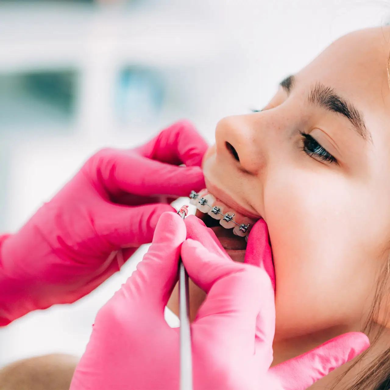 braces for teeth